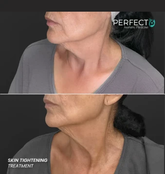 Non-Surgical Treatments for Sagging Skin in Doral, FL