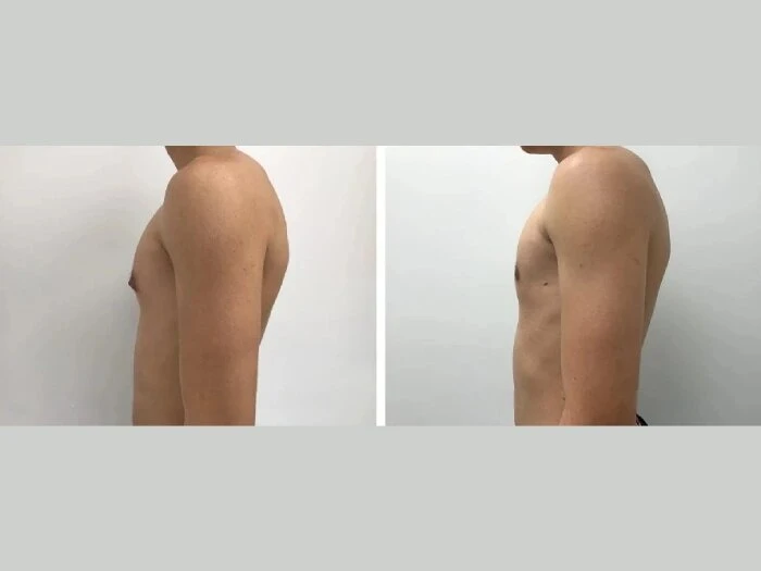 Gynecomastia Packages in Dubai: Best Value Deals