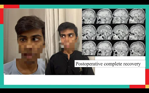 How A Life Saving Endoscopic Surgery Restored Vision & Hormones In A Young Man: A Pituitary Apoplexy Treatment Success