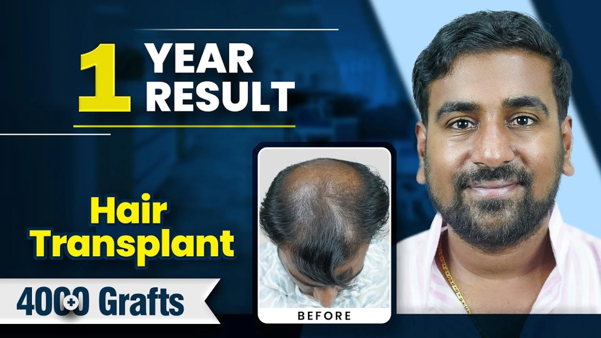 Our Patient Ketan Bhandari 1 Year Hair Transplant Journey