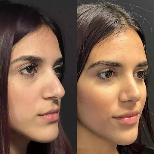 Best Rhinoplasty Surgeon in Dubai for Customized Treatment Plans