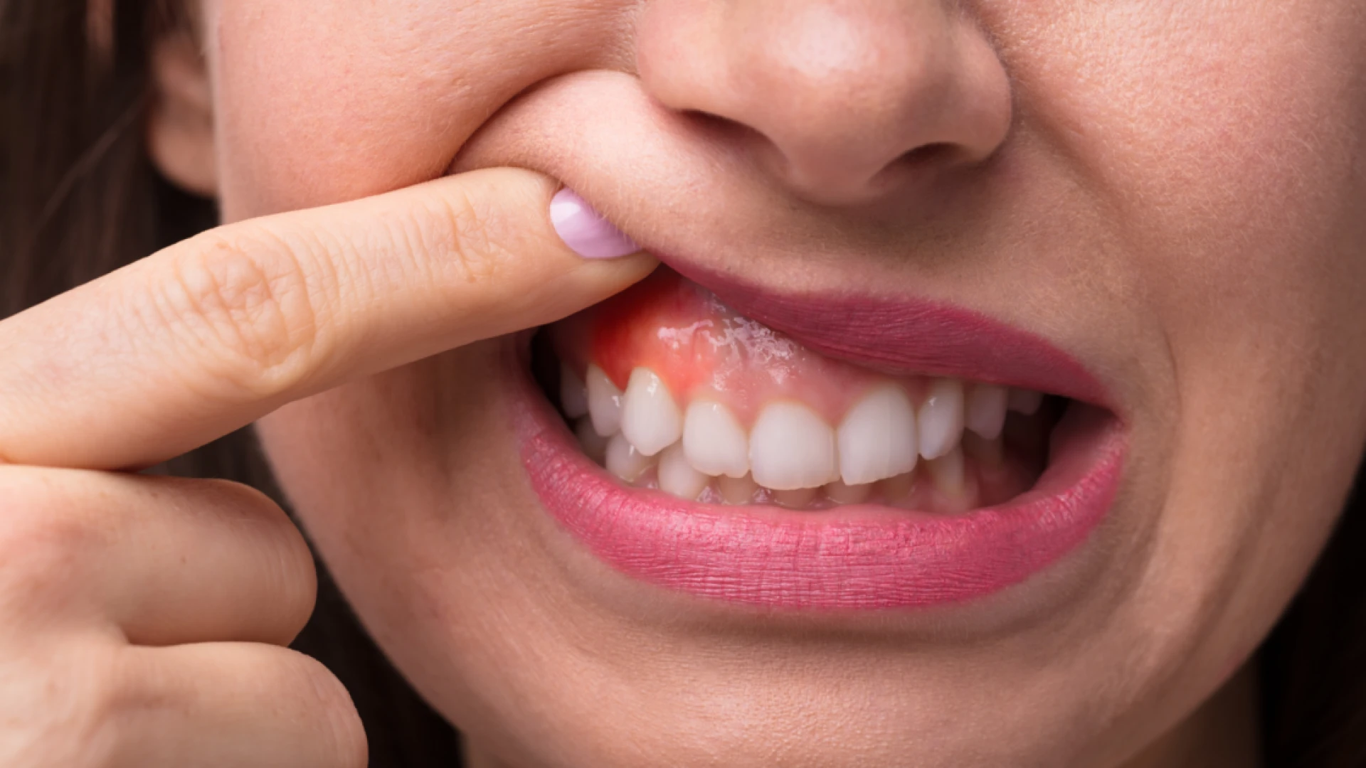 Understanding Gummy Smiles: Why They Happen and How They’re Treated