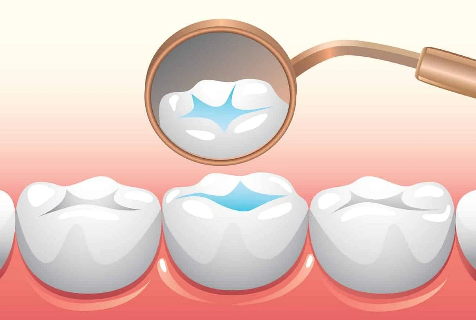 Draft: My PoDental Sealants Market Forecast Report: Demand Dynamics, Technological Advancements, and Market Expansionst Title