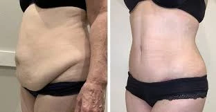 Does Liposuction in Islamabad Require Anesthesia?