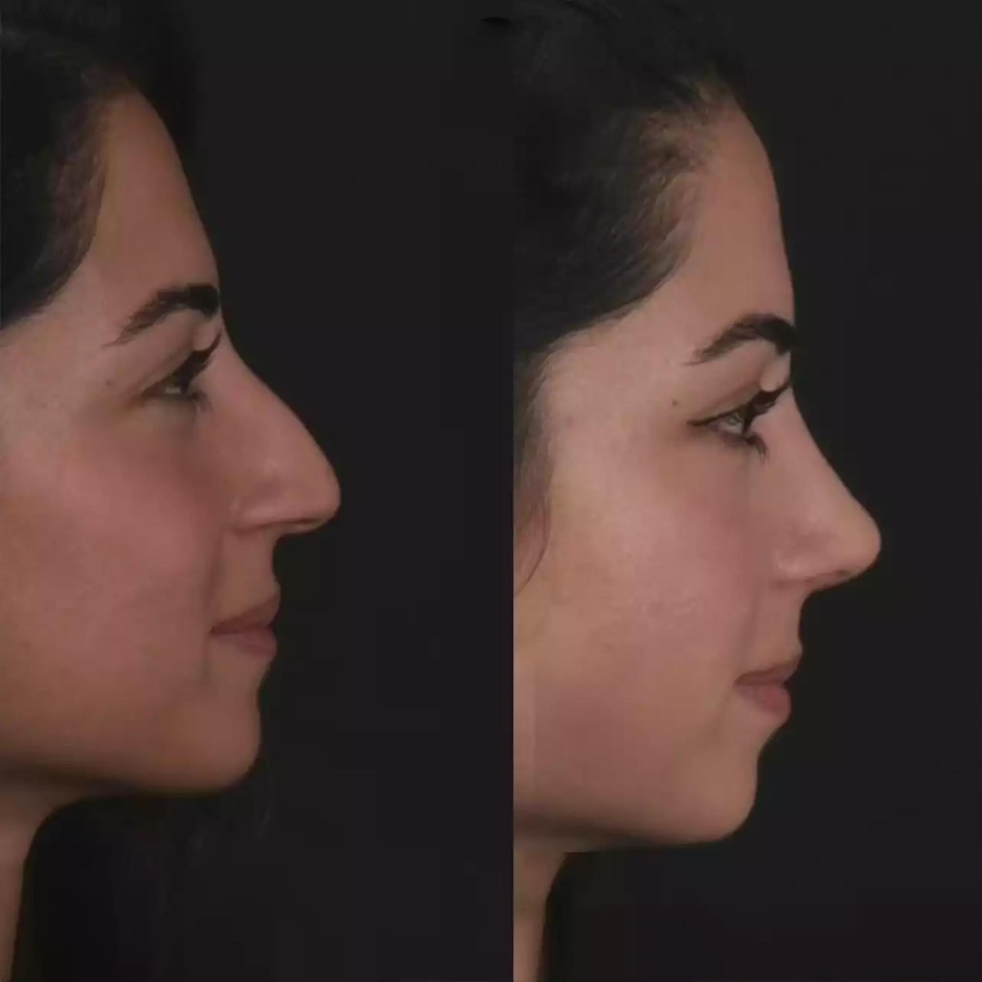 Regain Control of Your Breathing with Septoplasty in Dubai