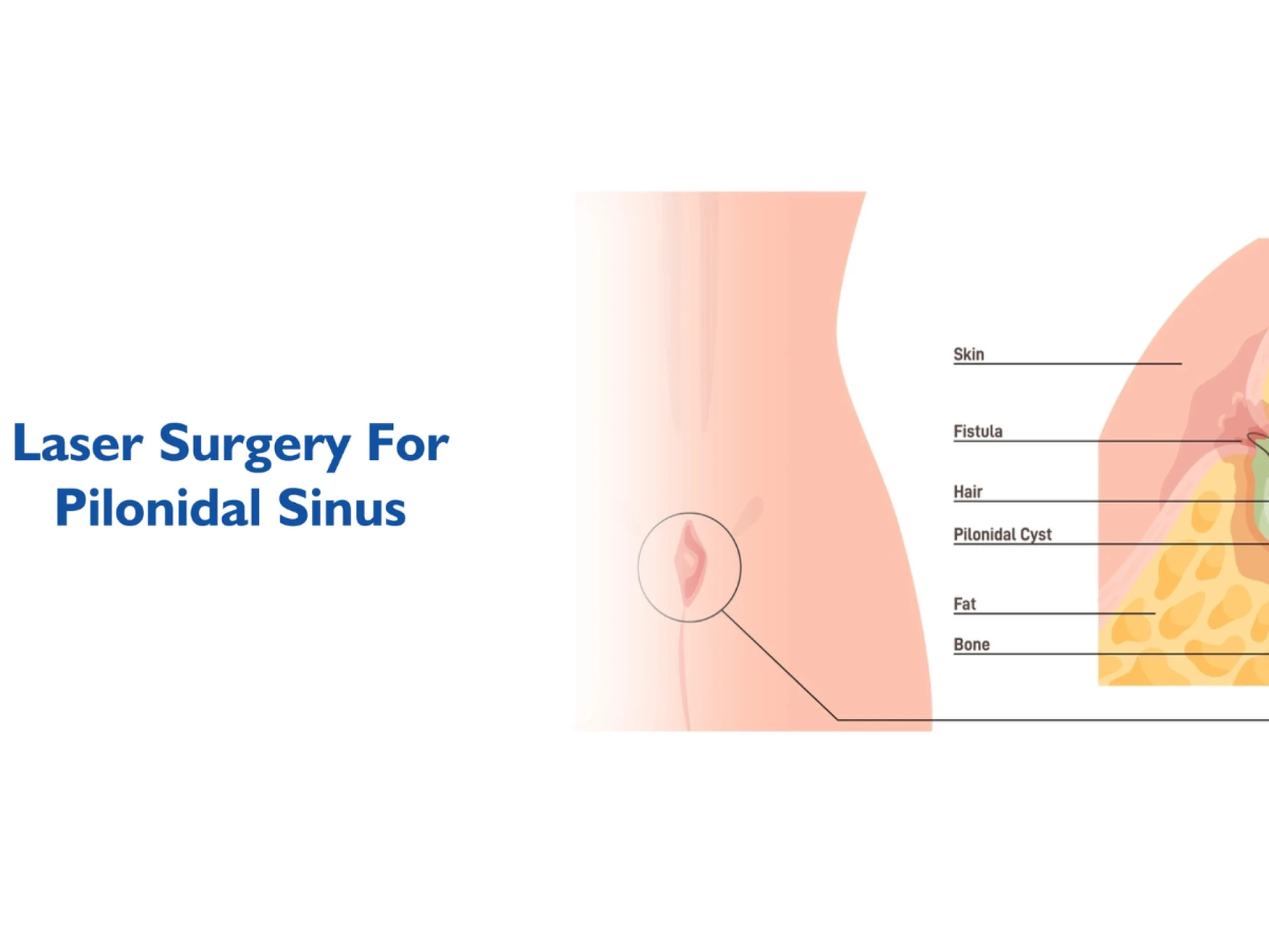 Essential Tips for Pilonidal Sinus Recovery