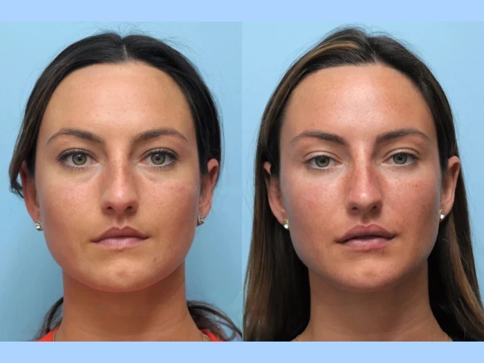 Achieve a Naturally Lifted Look with Thread Lift Treatment in Dubai