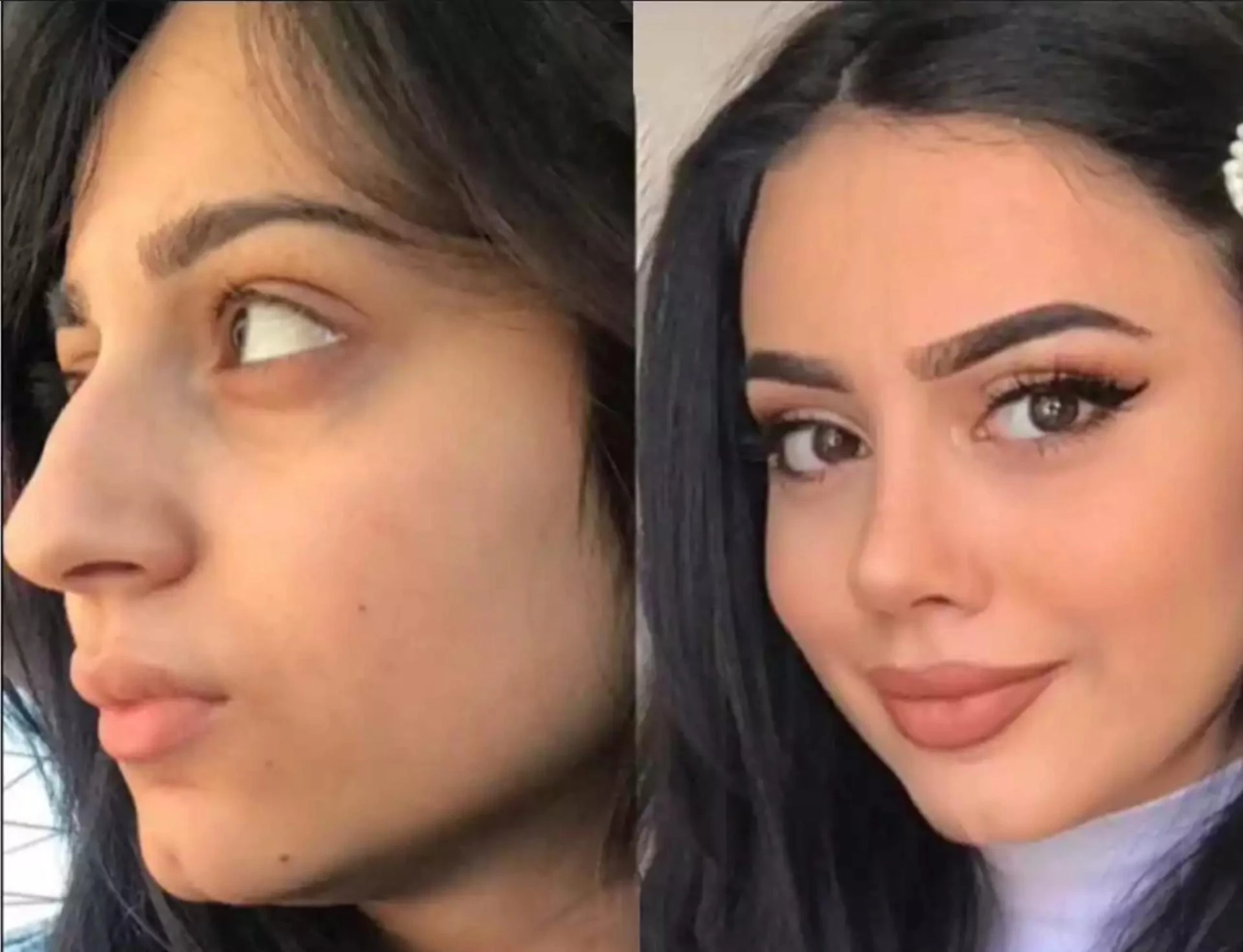 Is Nose Surgery in Dubai Safe? What Surgeons Don’t Advertise Publicly