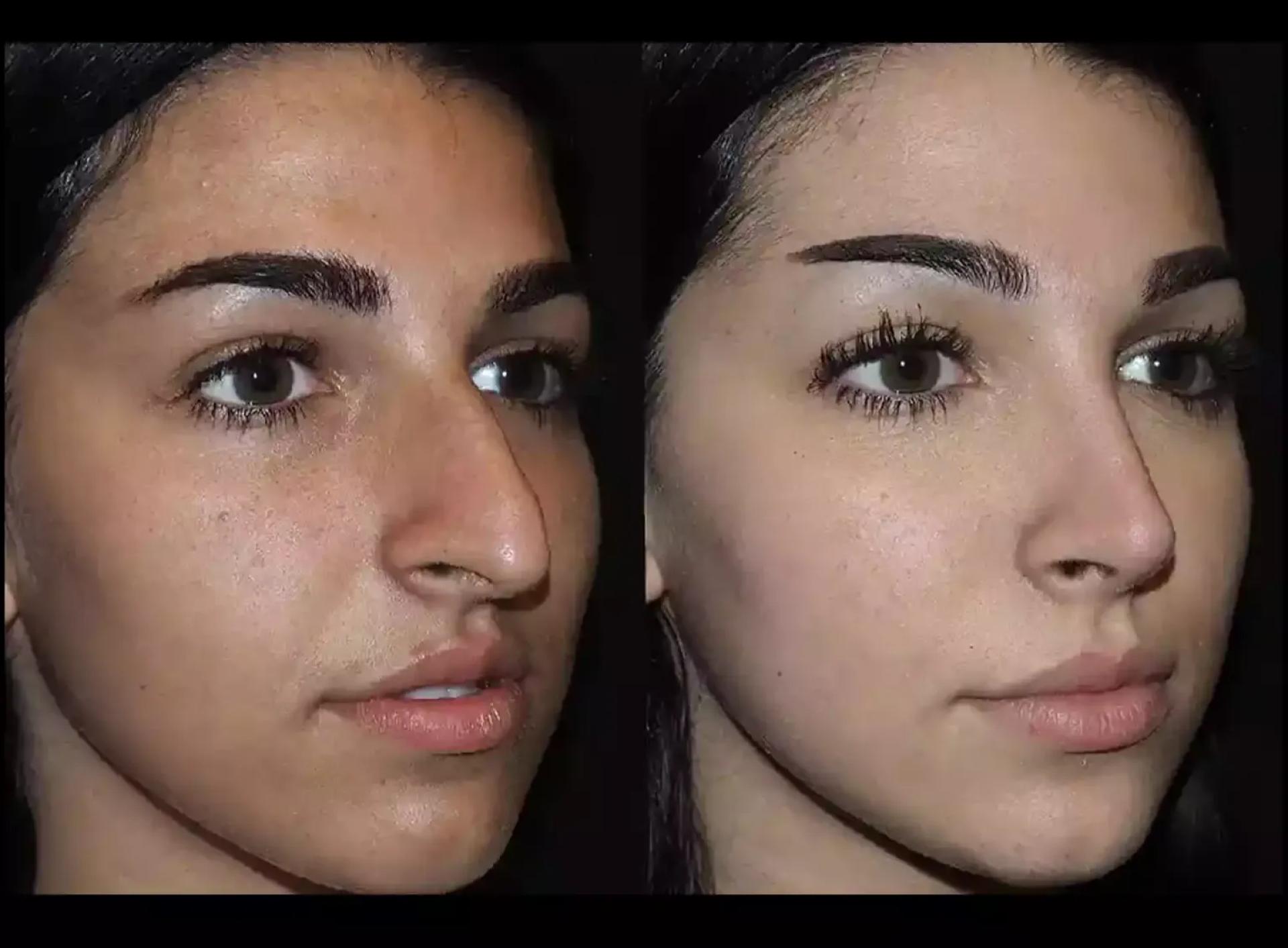 Septoplasty in Dubai: Trusted Doctors for Deviated Septum Correction