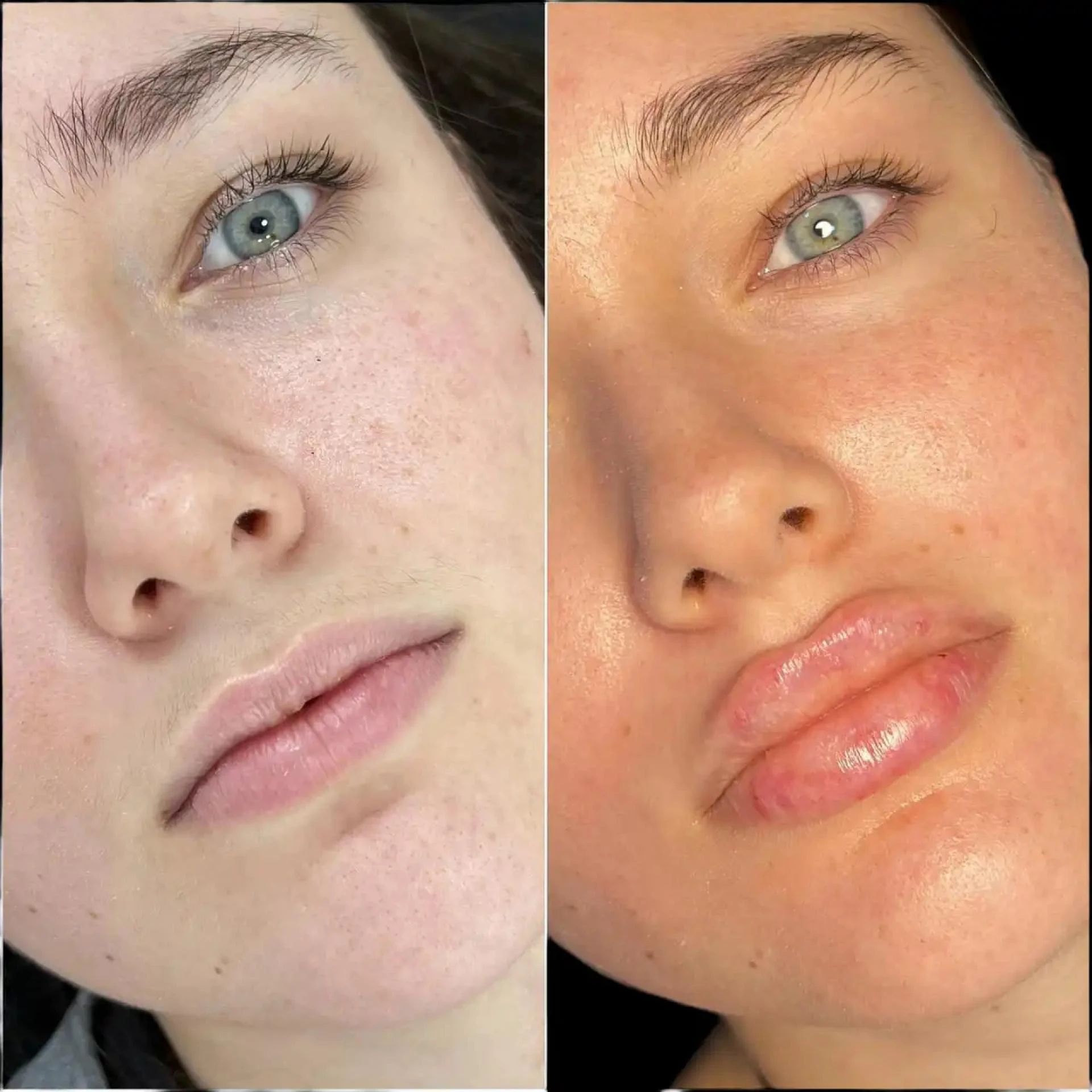 Best Doctors in Dubai for Fillers to Achieve a Natural Glow