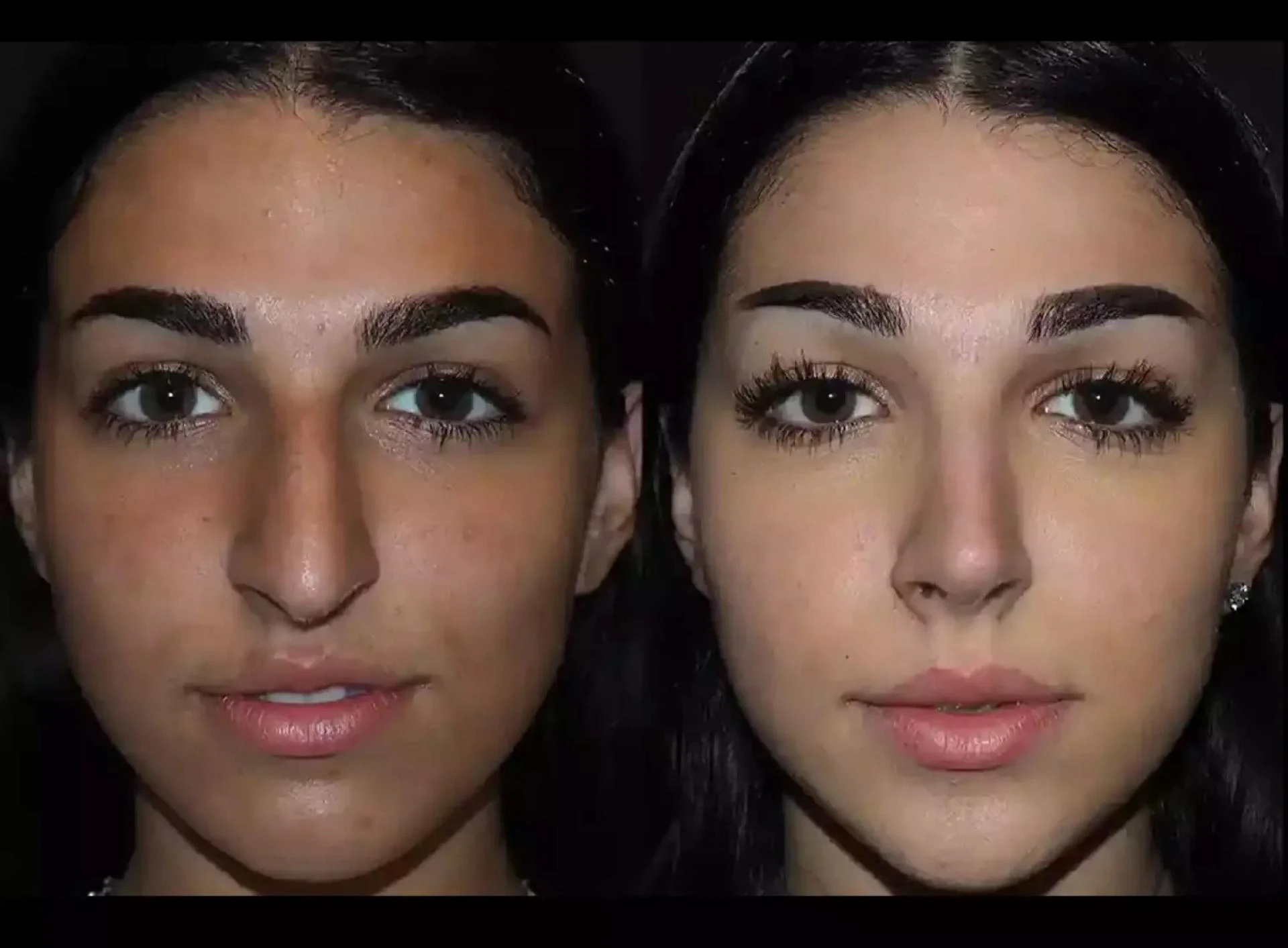 Enhancing Quality of Life with the Best Septoplasty Surgeon in Dubai