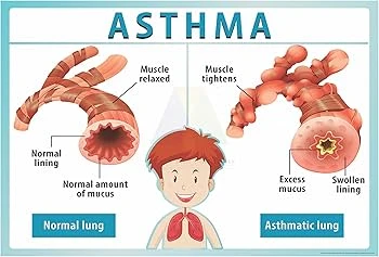 Breathing New Life into the Ganges' Breeze – How Dr. J.K. Samaria is Transforming Asthma Care in Varanasi