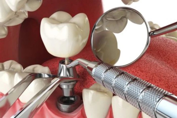 Dental Implants: Why They’re the Best Investment for Your Smile