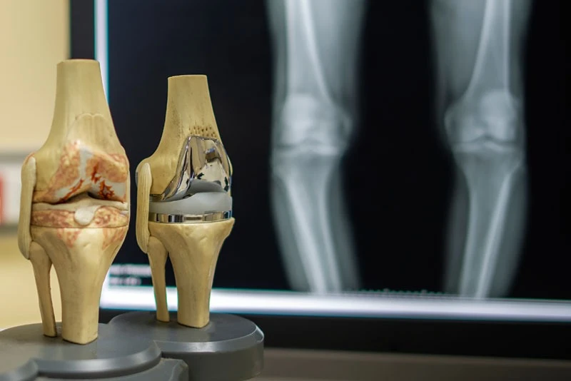 How Does Humidity Impact Your Joints?