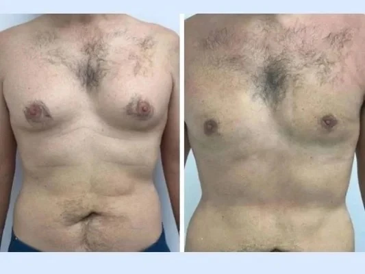 How Laser-Assisted Methods Techniques Improve Gynecomastia Surgery in Dubai