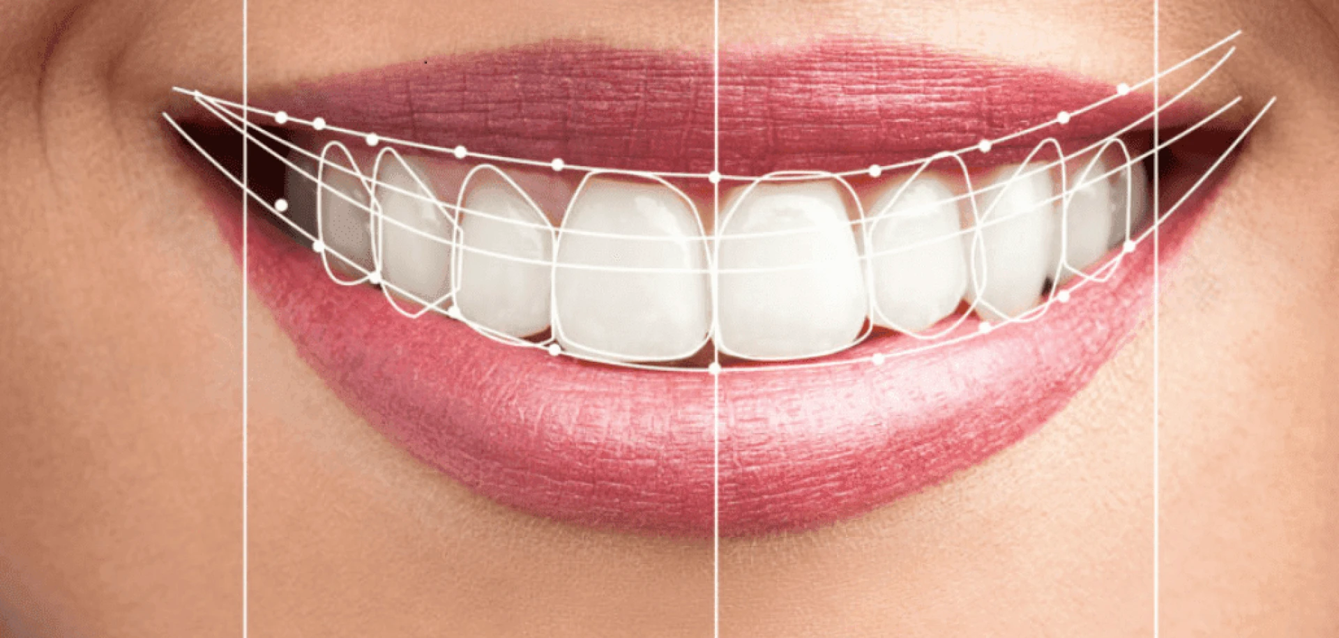 Hollywood Smile in Dubai – Shine Like a Star