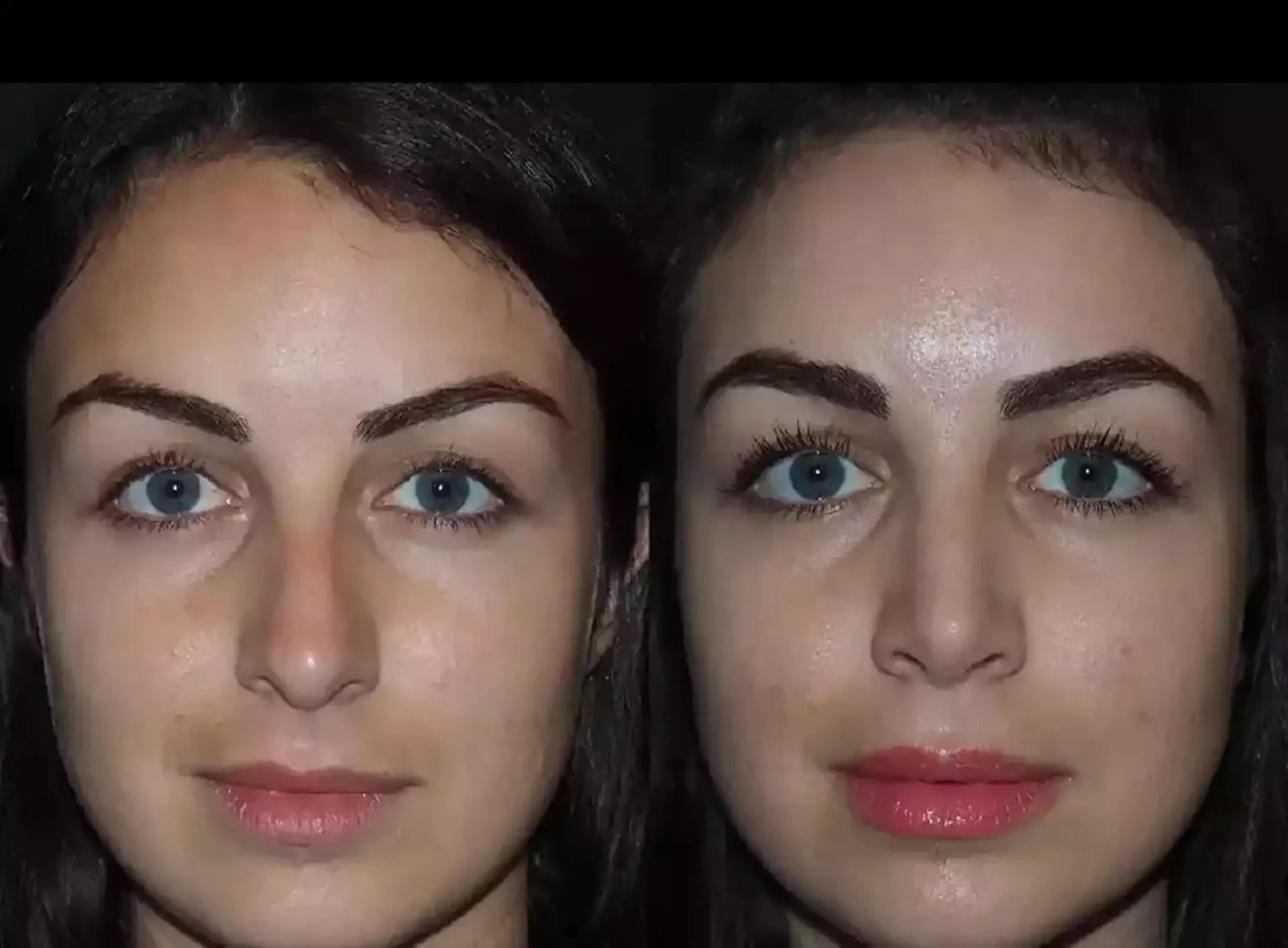 How Do the Best Doctors in Dubai Ensure Safe Septoplasty Outcomes?