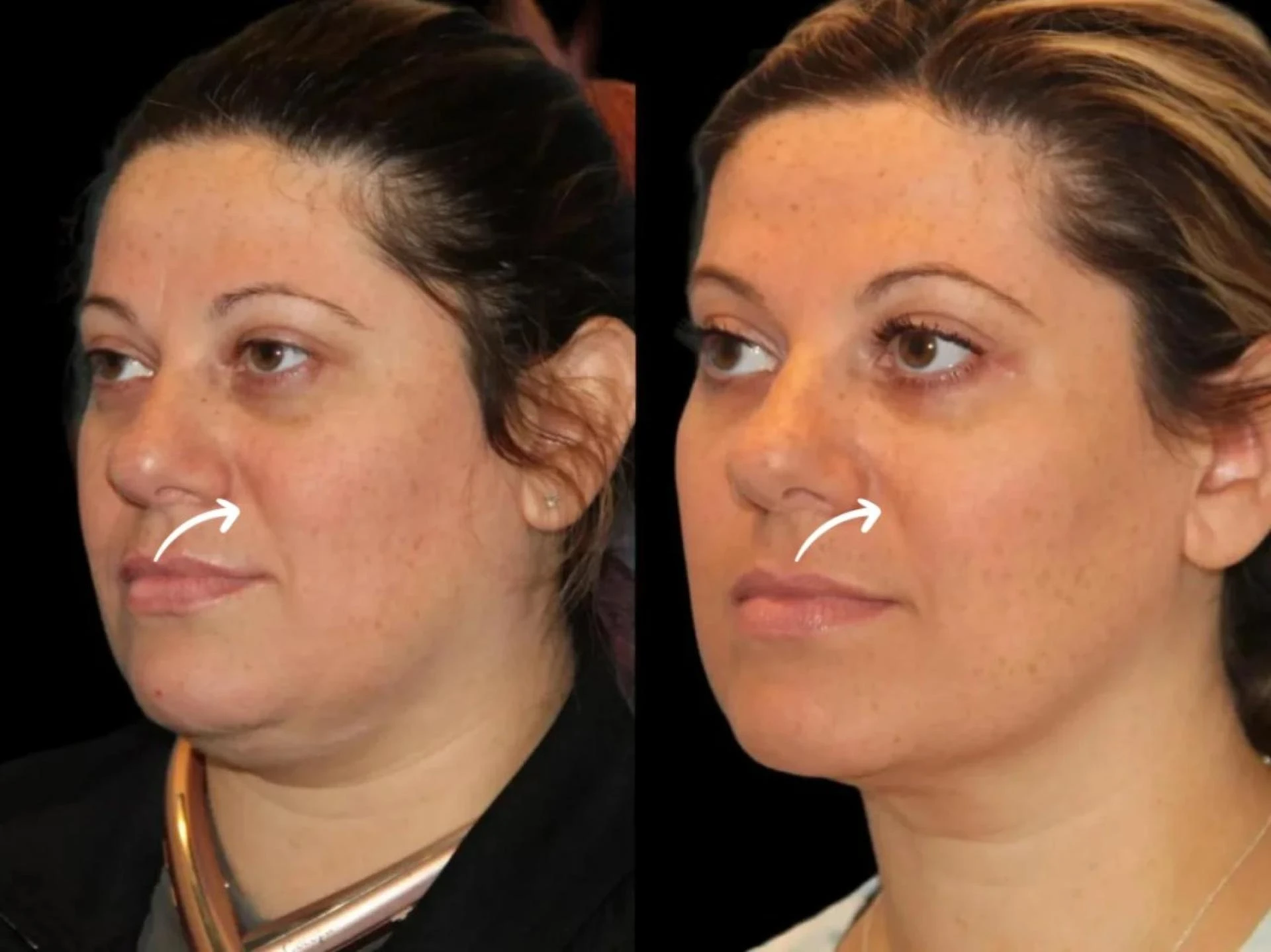 Sculptra Glow Techniques by Best Doctors in Dubai
