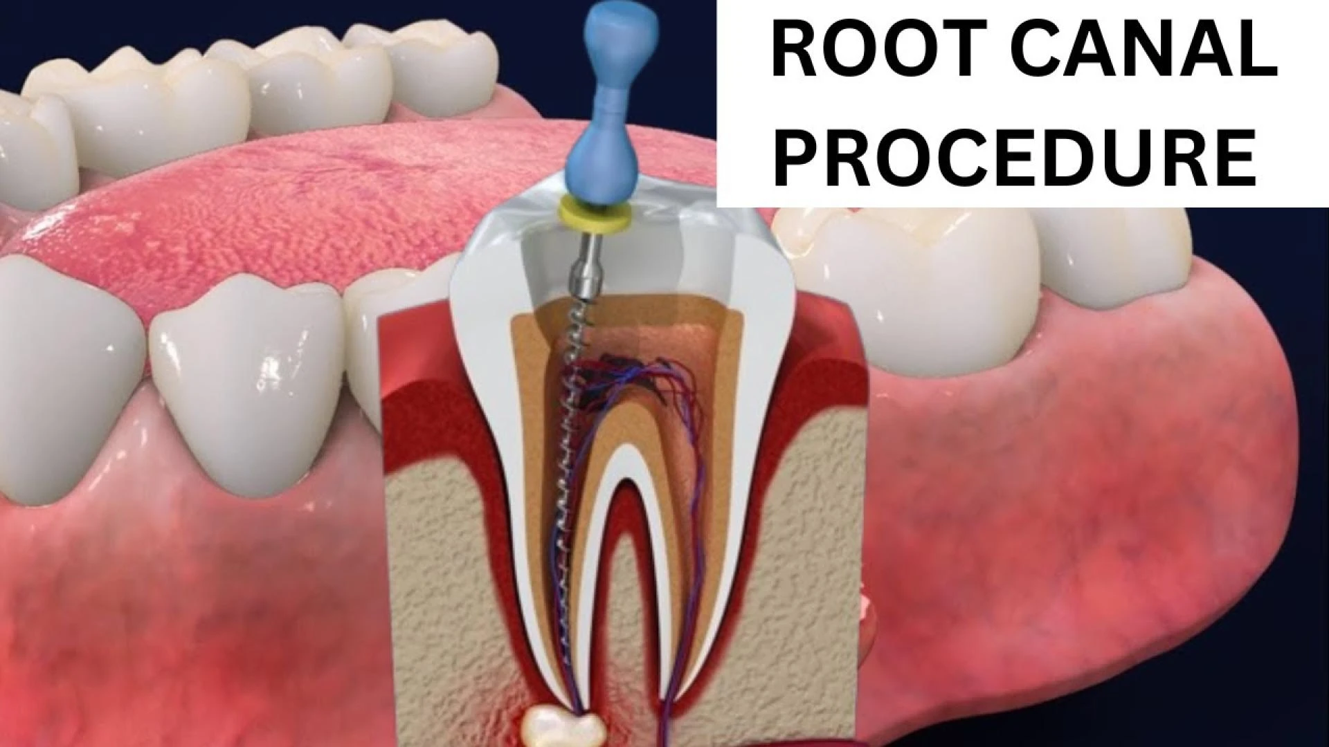 5 Easy Steps to Save Your Tooth with Root Canal Treatment