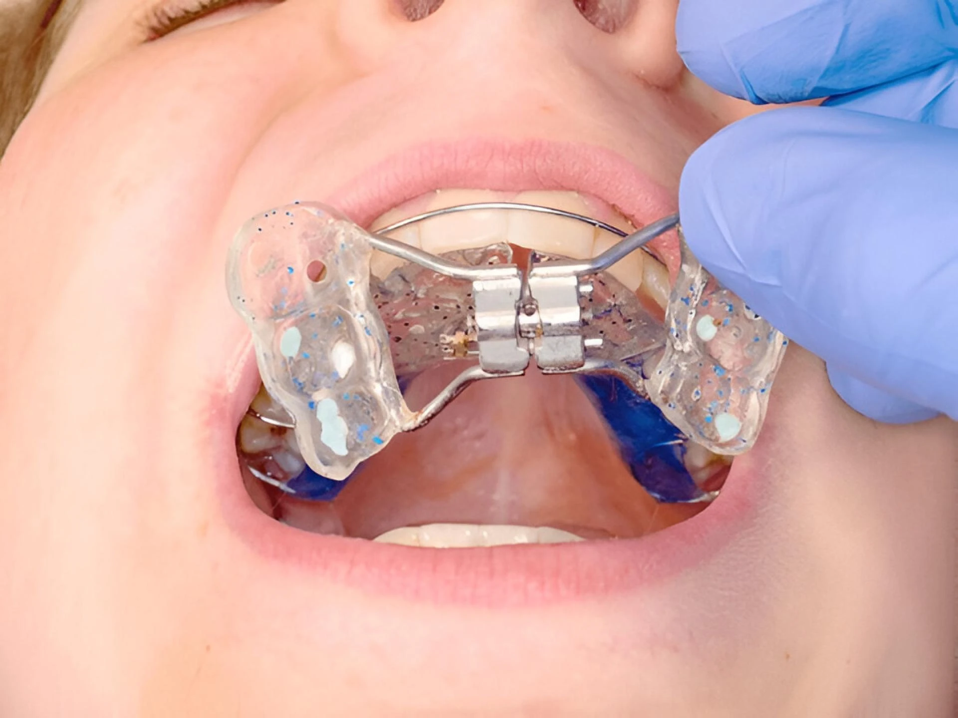 A Complete Guide to the Removable Palatal Expander