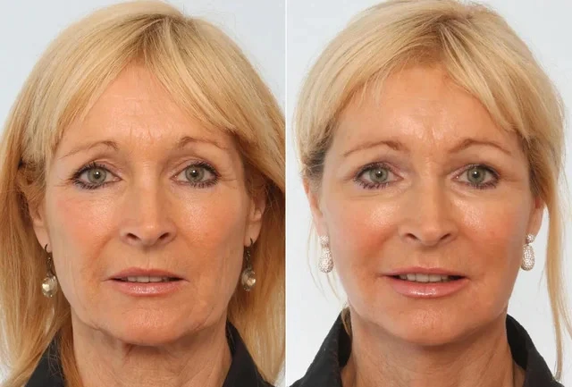Face Lift Cape Town South Africa — Reclaim a Youthful Contour
