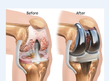 Understanding the Cost of Total Knee Replacement Surgery in Delhi for Better Planning