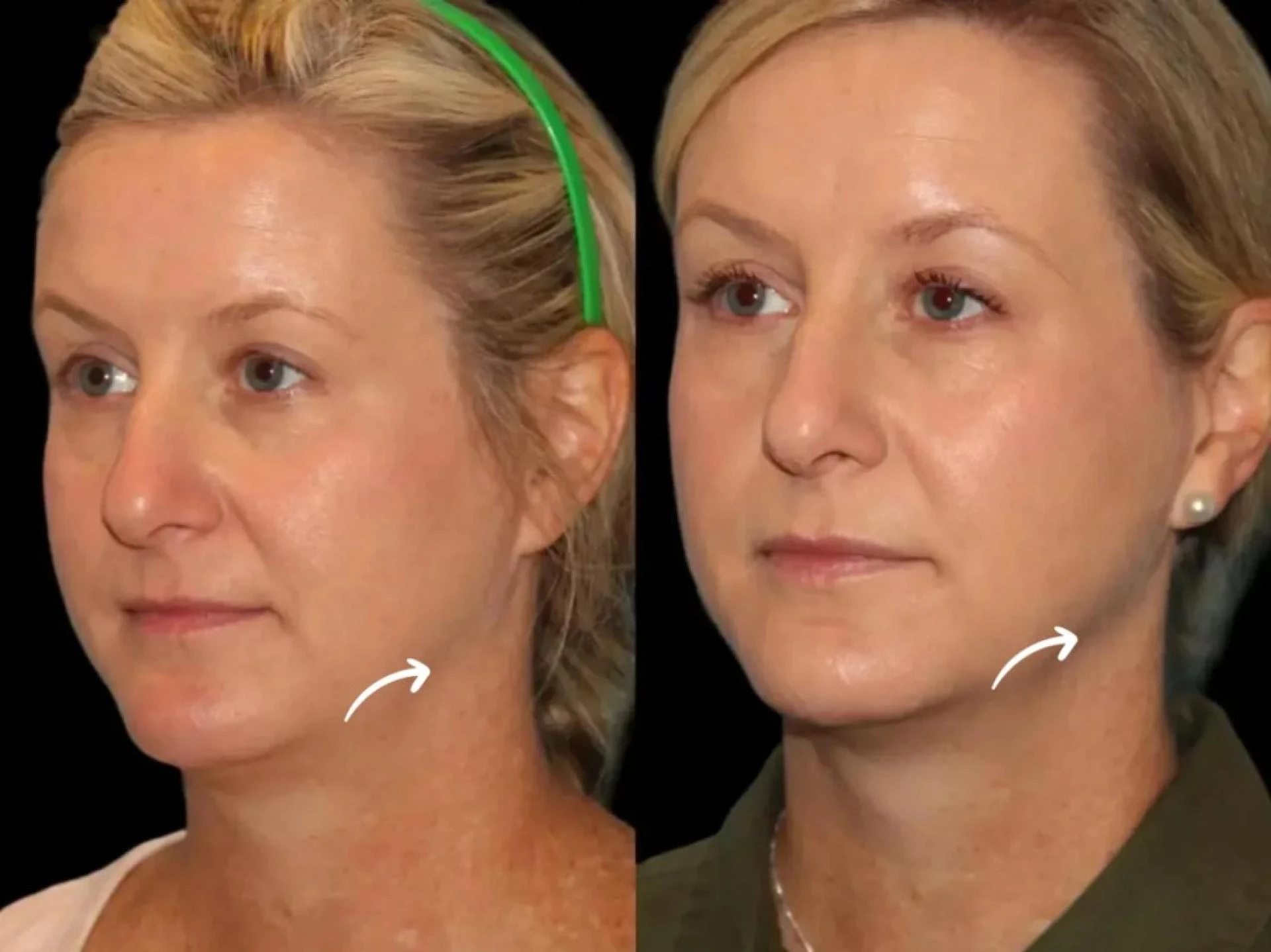 Sculptra Fitness-Friendly Treatments by Best Doctors in Dubai