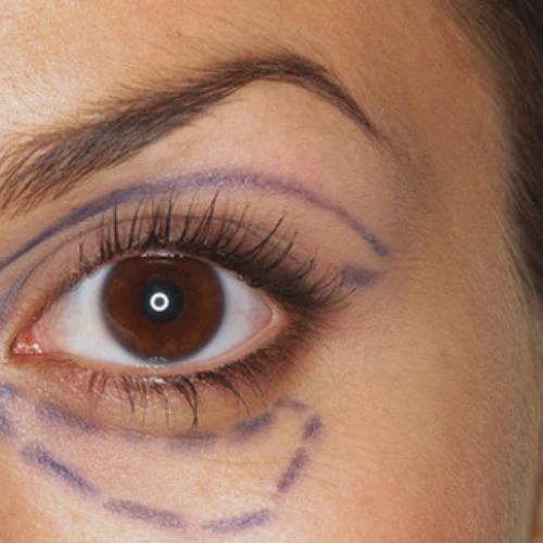 Lower Blepharoplasty Cape Town: The Ultimate Solution for Under-Eye Bags