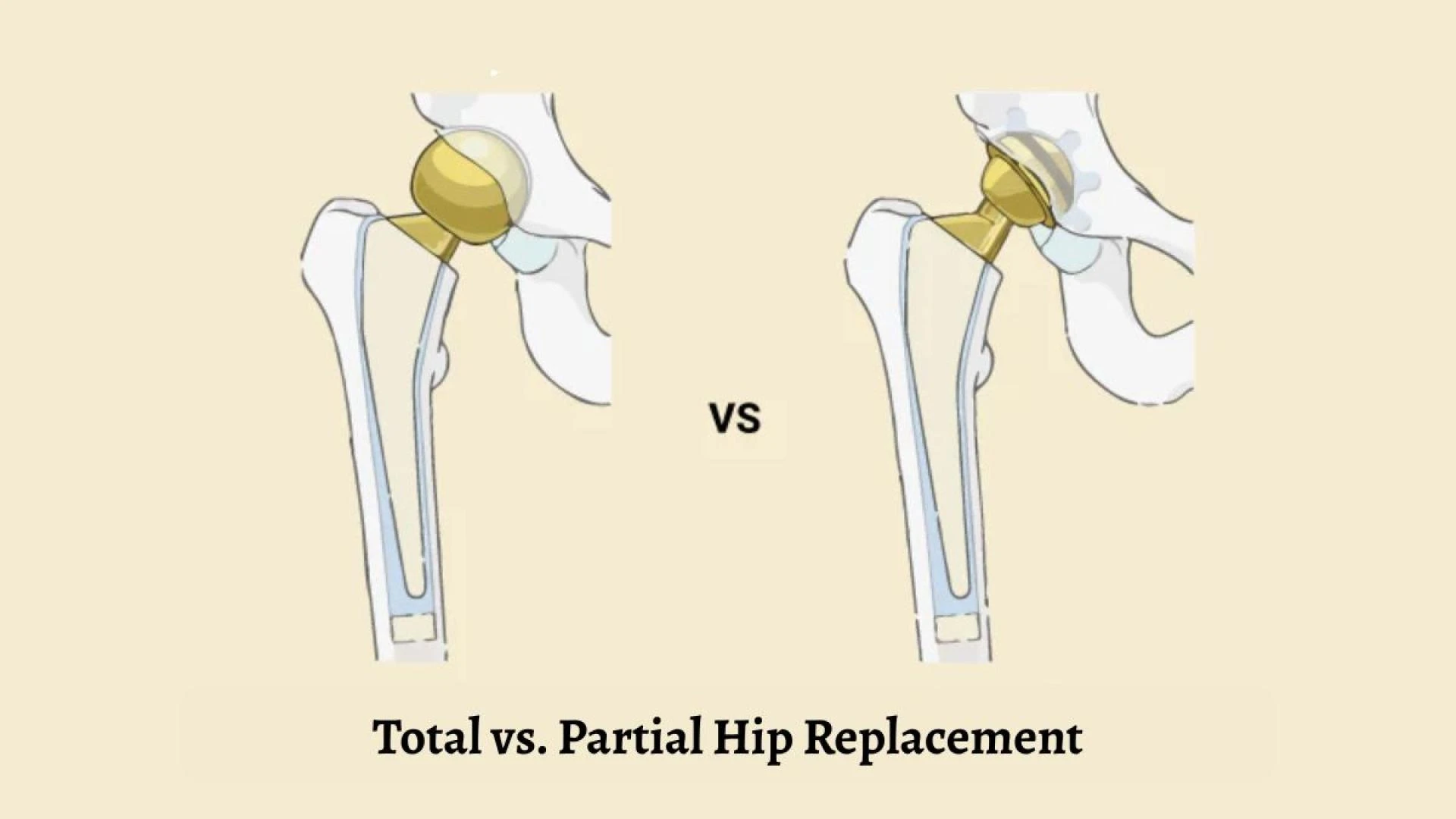 Total vs. Partial Hip Replacement: Which One is Right for You?