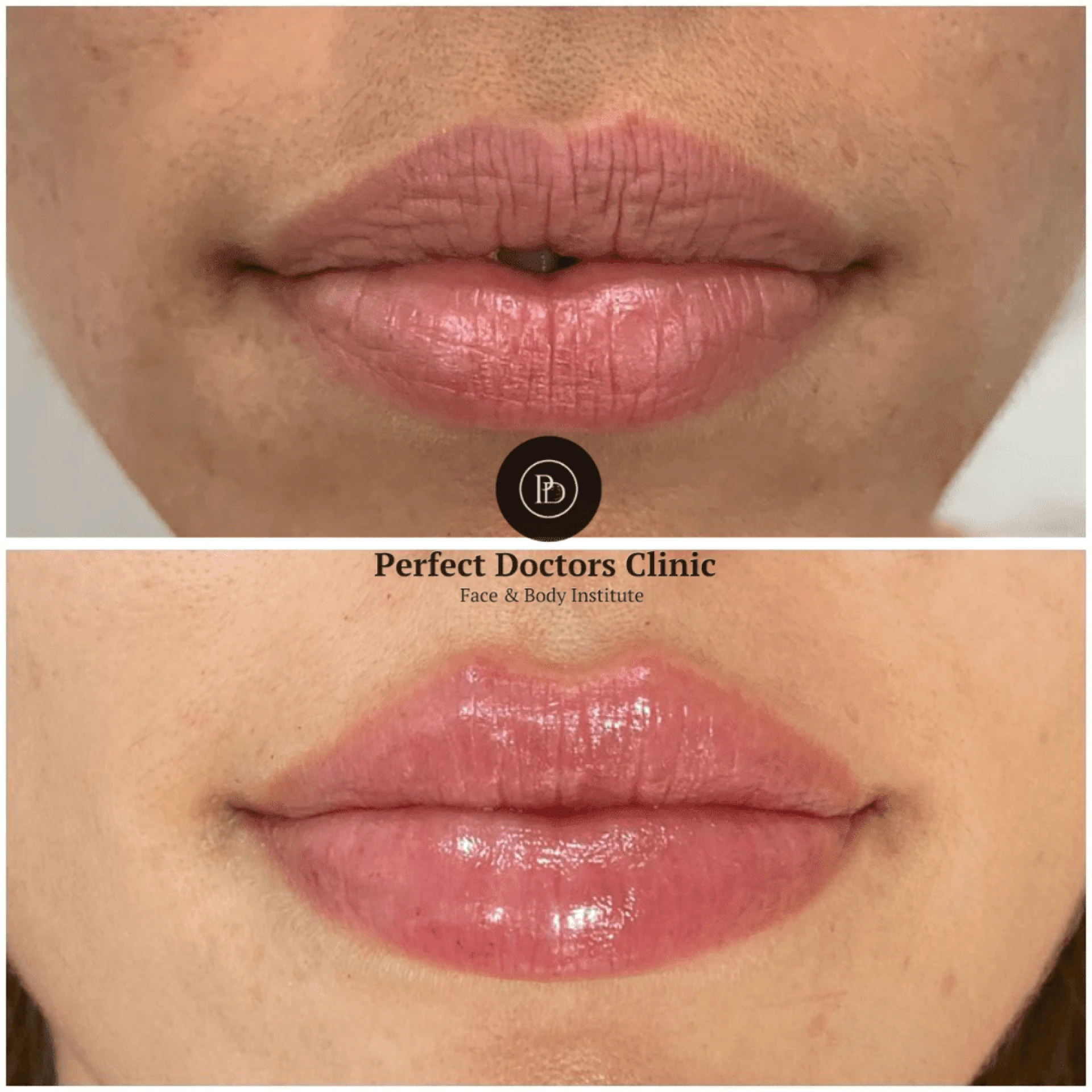 Juvederm for Subtle Lip Plumping: Guidance by Best Plastic Surgeons in Dubai