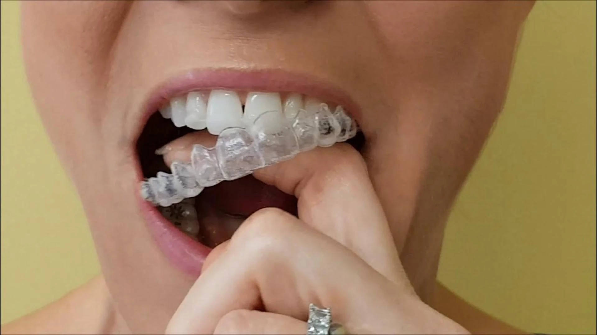 Clear Aligners vs Braces in Texas: What’s Right for You 