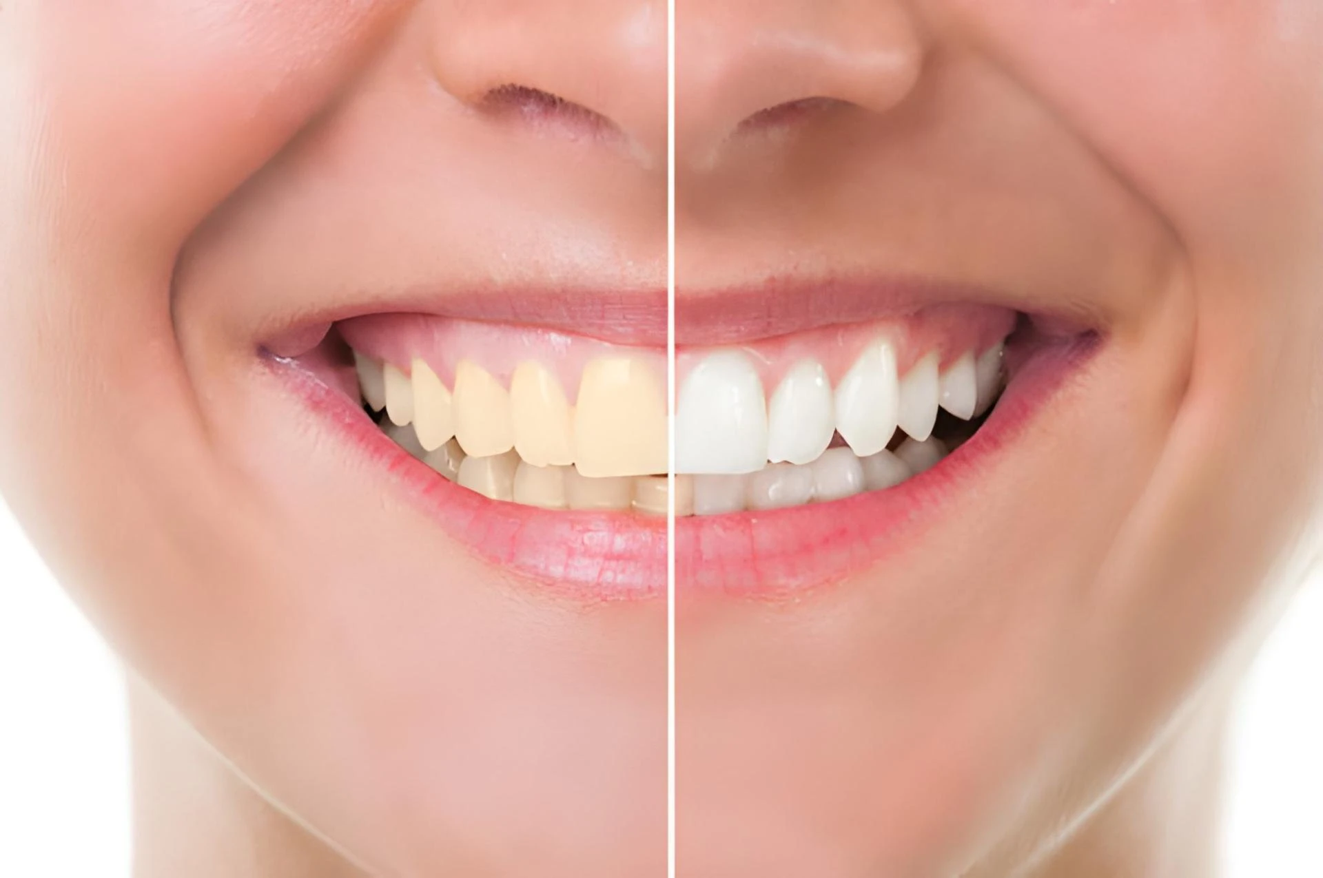 Top Teeth Whitening Options: What Irving, TX Patients Should Know