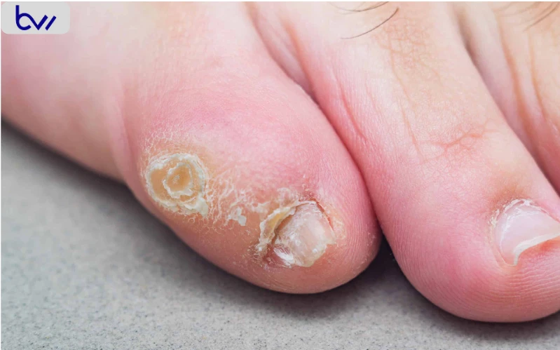 Foot Corn Disease