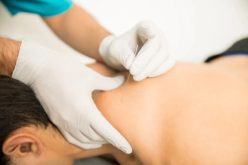 Can Acupuncture Treat Insomnia and Sleep Disturbances Effectively