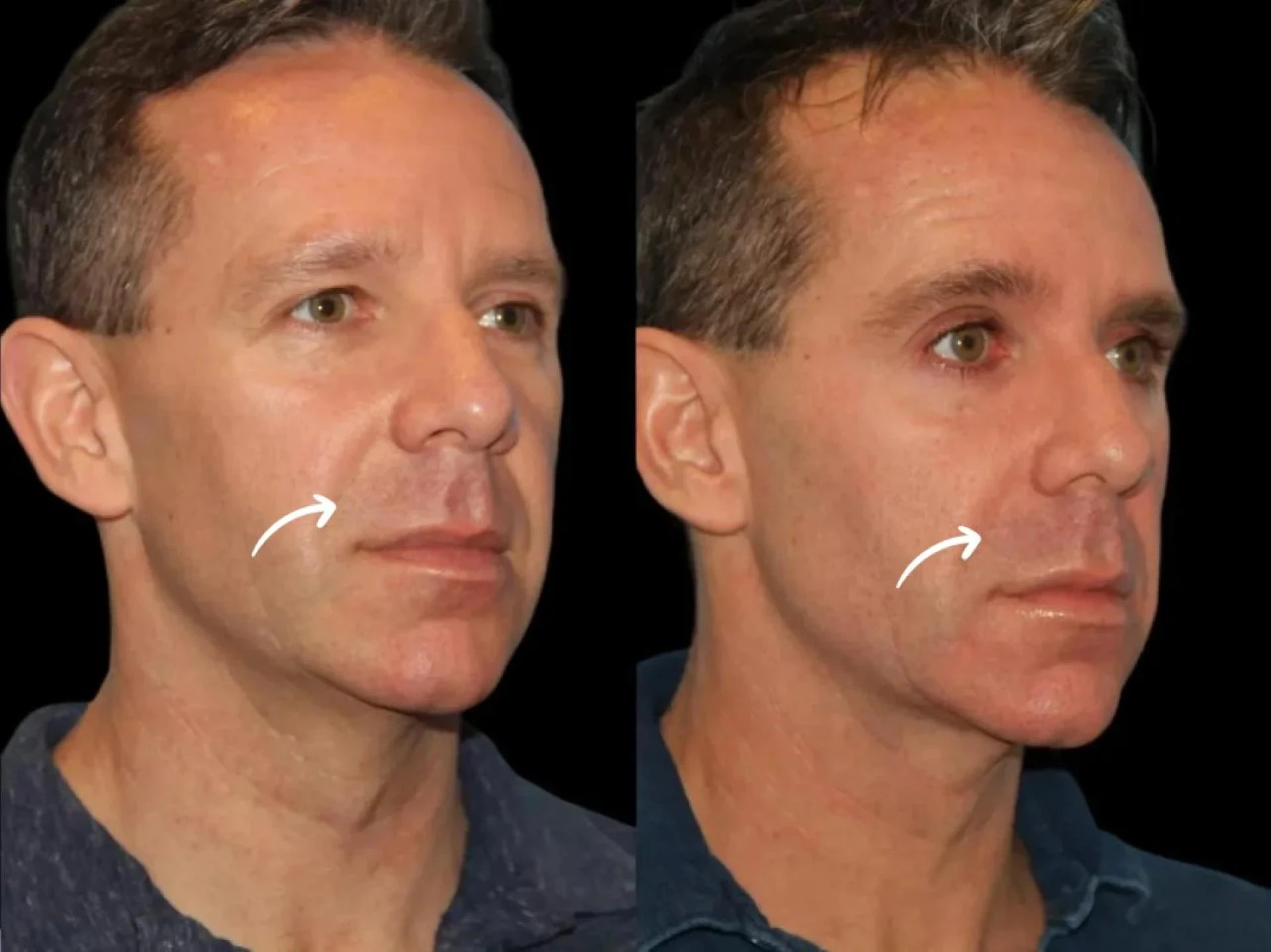 Best Plastic Surgeon in Dubai on Sculptra for Facial Wellness
