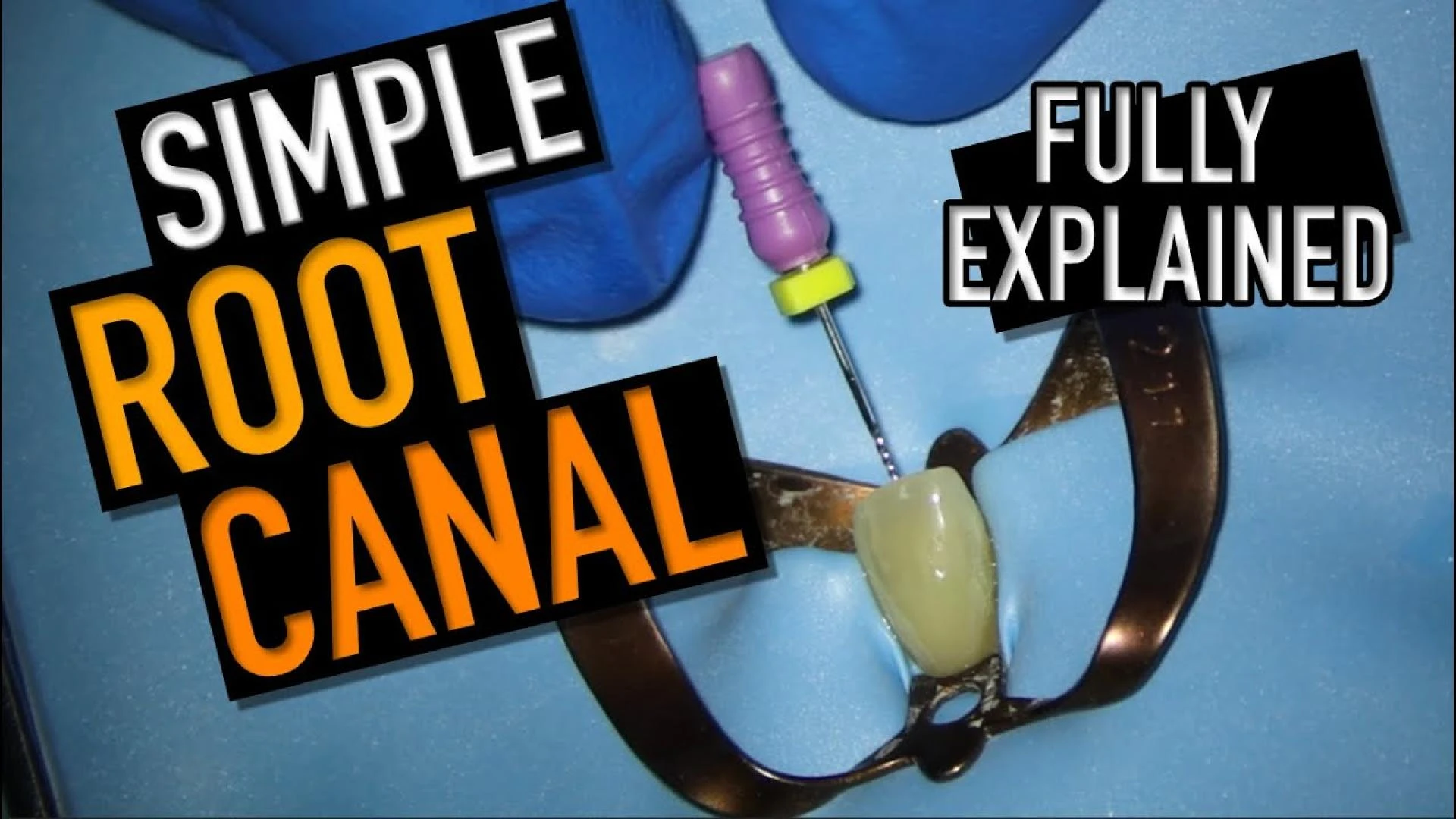Which Dentist Does Root Canal in Dallas? Complete Guide 