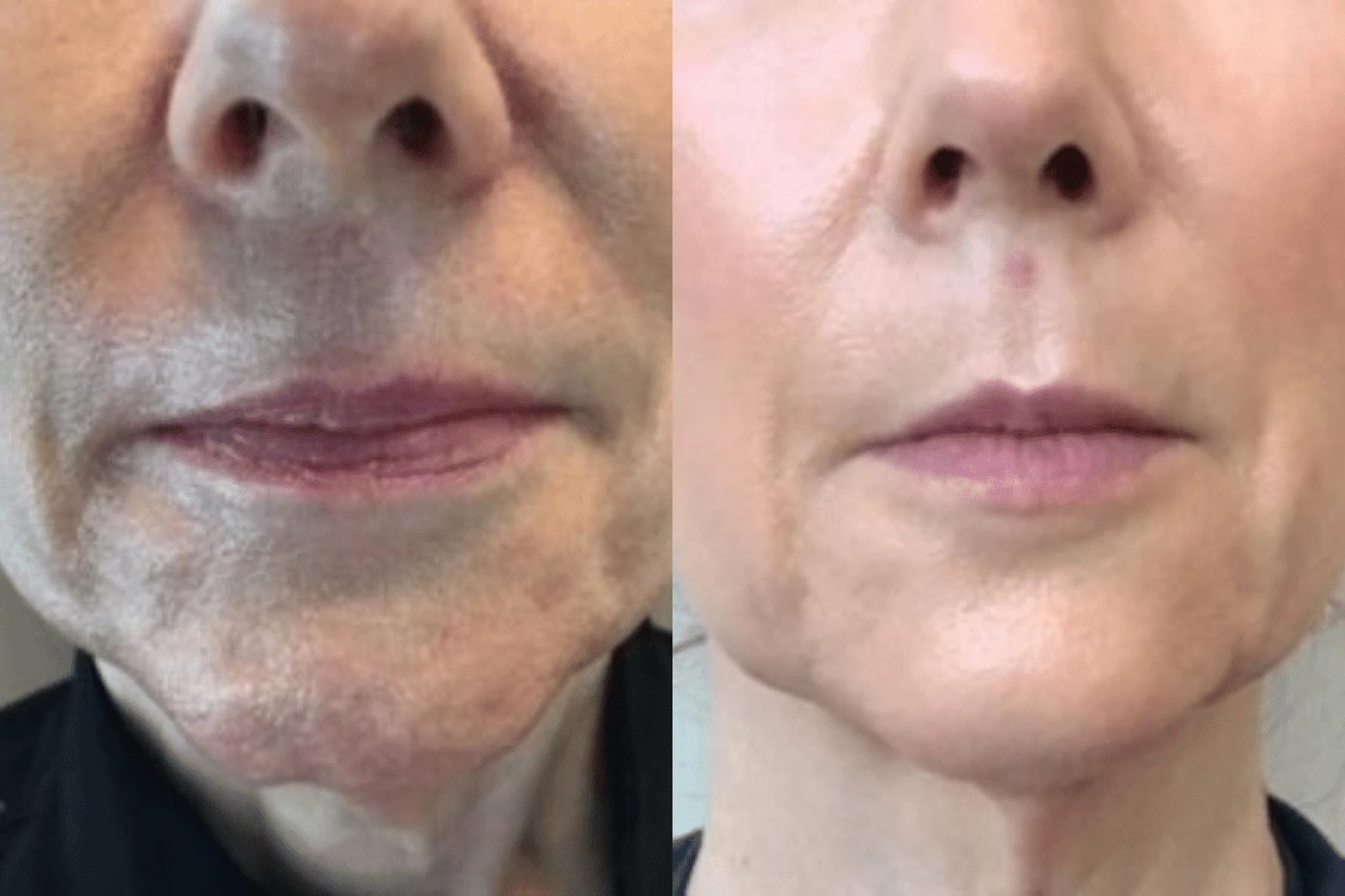 Could Botox Chin Before and After Be Your Next Glow-Up?