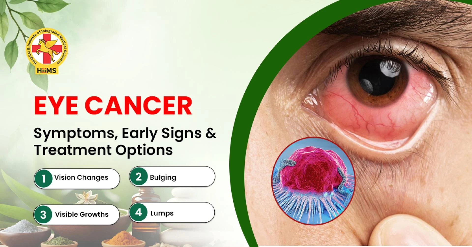 Eye Cancer: Symptoms, Early Signs & Treatment Options