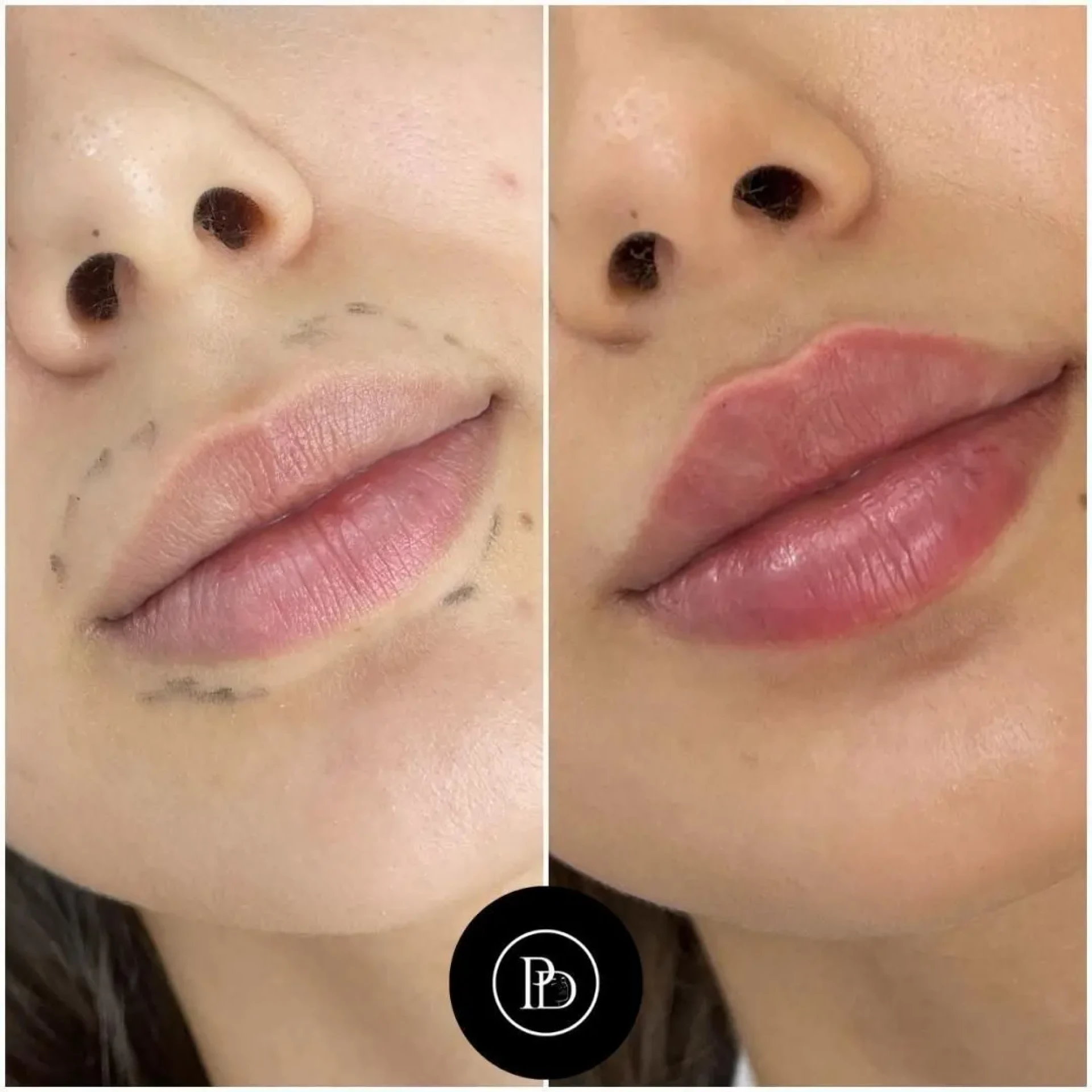 Juvederm Safety Protocols Followed by the Best Plastic Surgeon in dubai