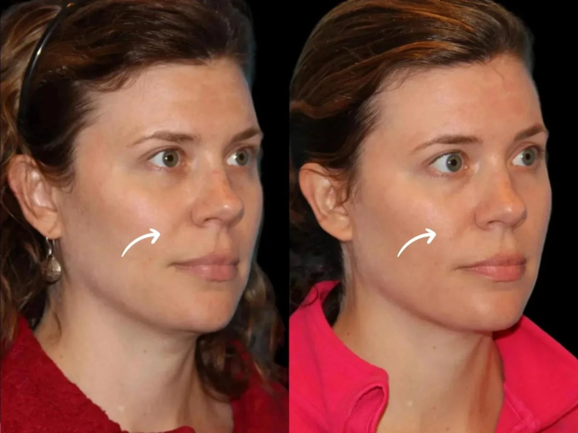 Best Plastic Surgeon in Dubai Sculptra Cell Renewal