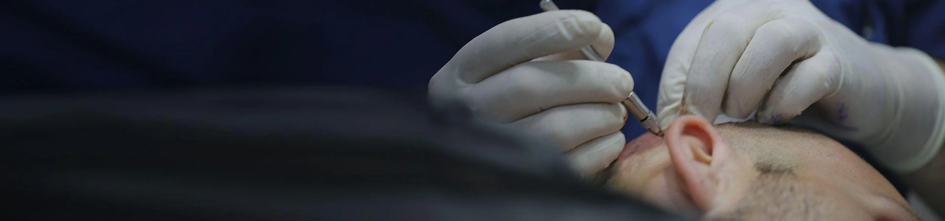 Things to Consider While Selecting the Best Afro Hair Transplant Turkey