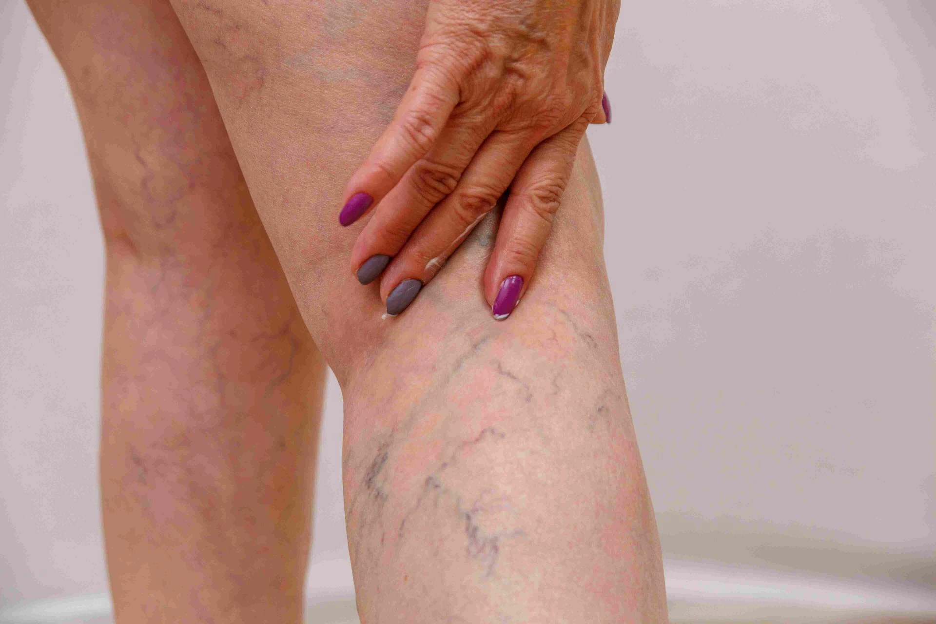 Sclerotherapy Explained: How Spider Vein Treatment Works & Its Benefits