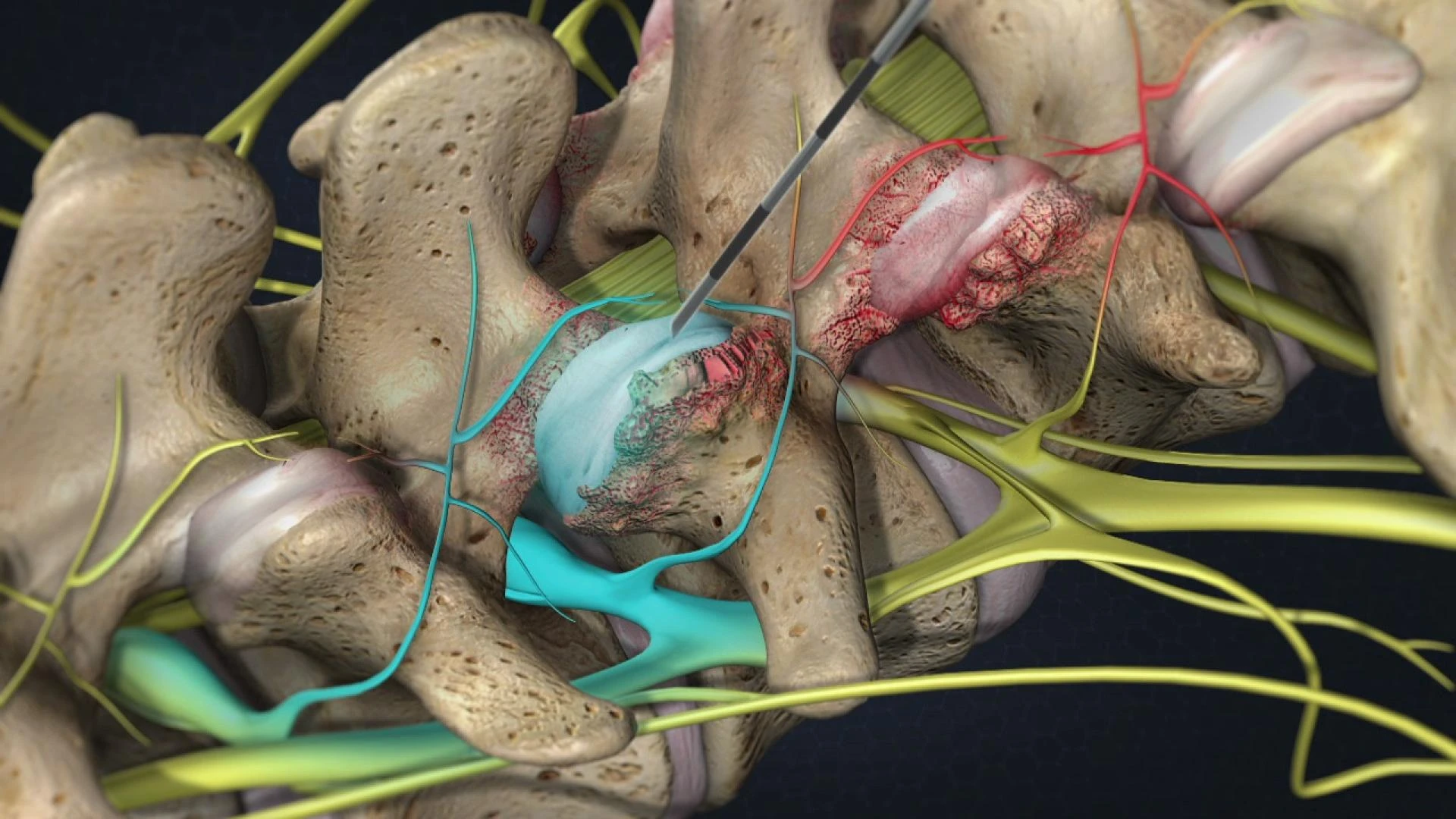 Facet Joint Syndrome Treament and Its Role in Restoring Spinal Comfort