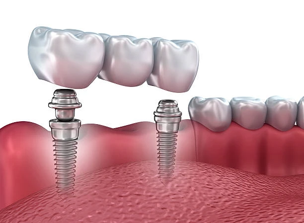 Implant Bridges vs Dental Bridges: Key Differences Explained