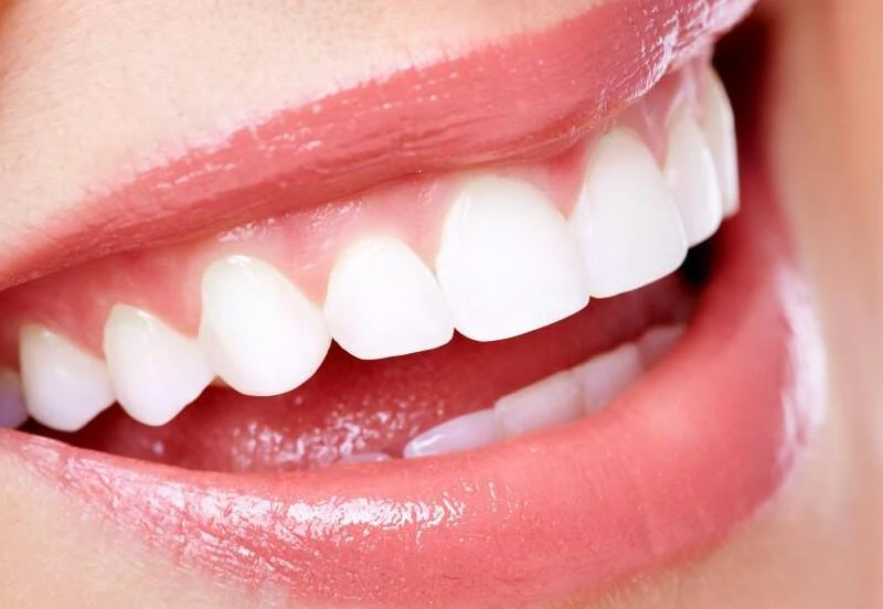 Dental Braces in Dubai: A Complete Guide to Straighter Teeth