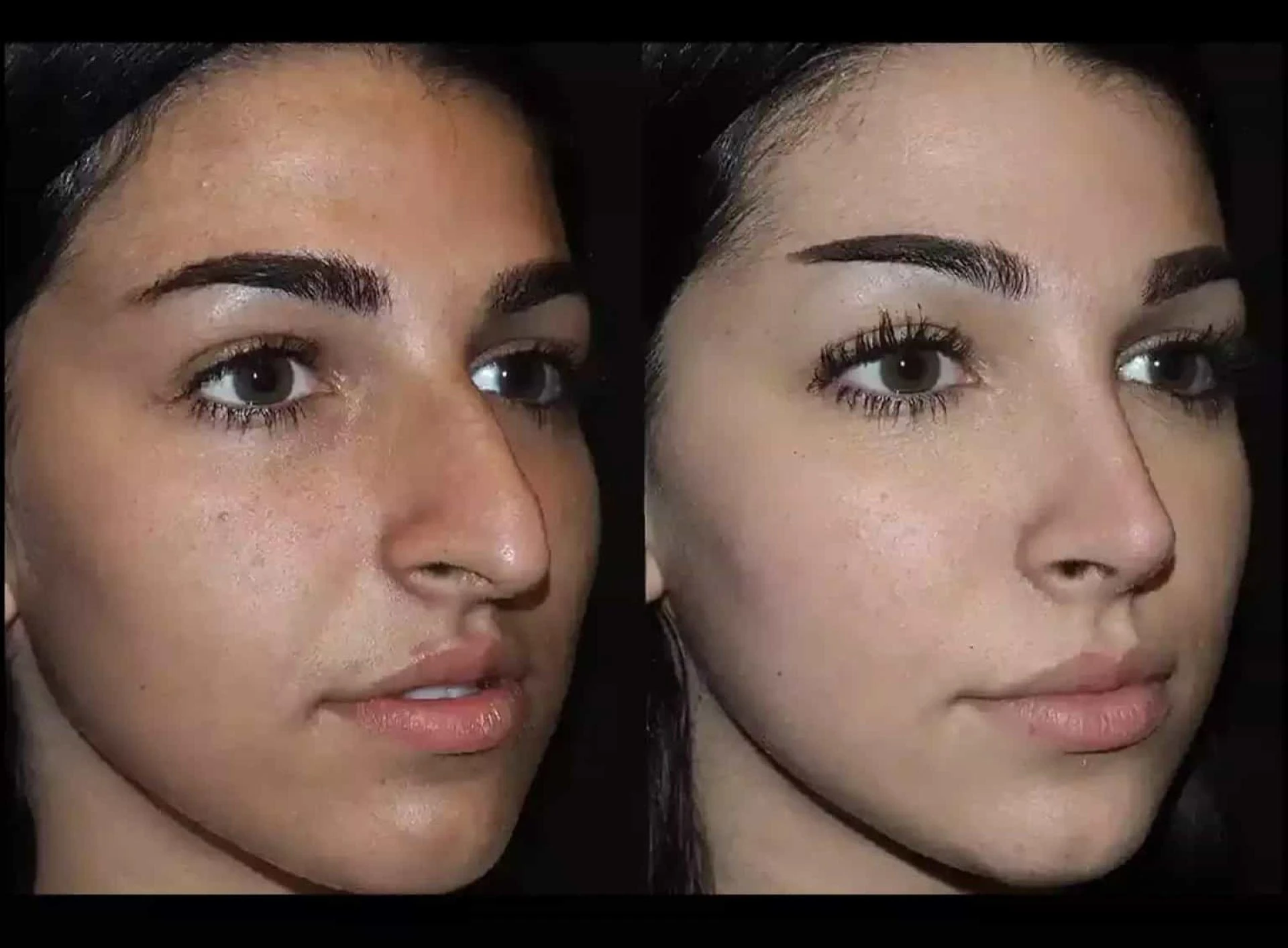 Best Septoplasty Surgeon in Dubai: Advanced Techniques and Outcomes