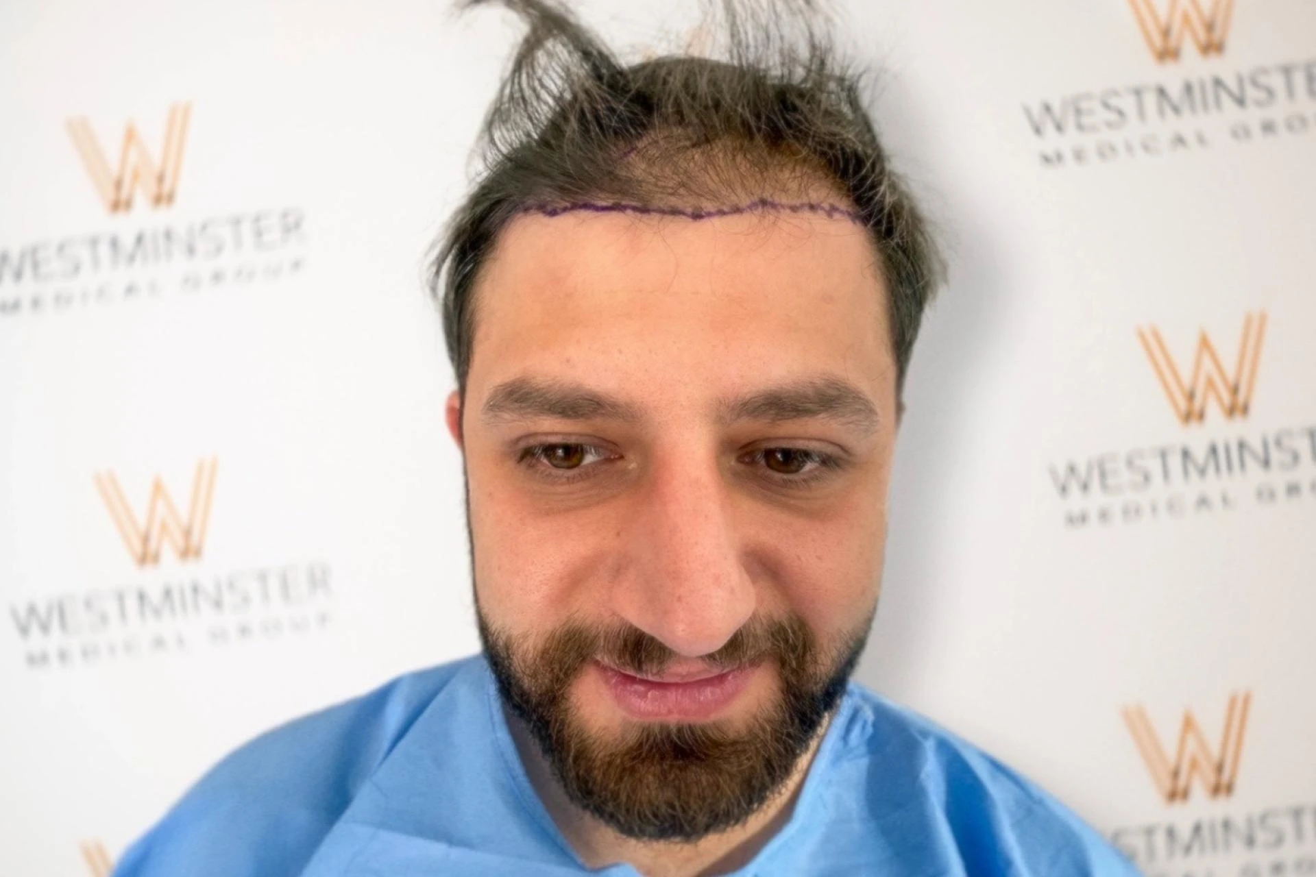 Hair Transplant Cost London: How Different Techniques Impact Your Budget