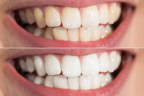 Professional Teeth Whitening in Bowie, MD: A Safe Way to Brighten Your Smile