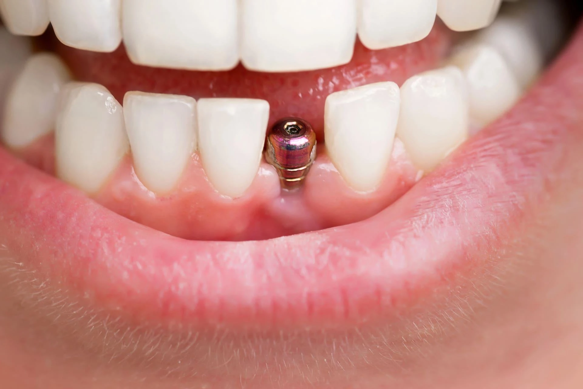 Trusted Dentist in Bella Vista & the Hills Area for Complete Dental CareDraft: My Post Title