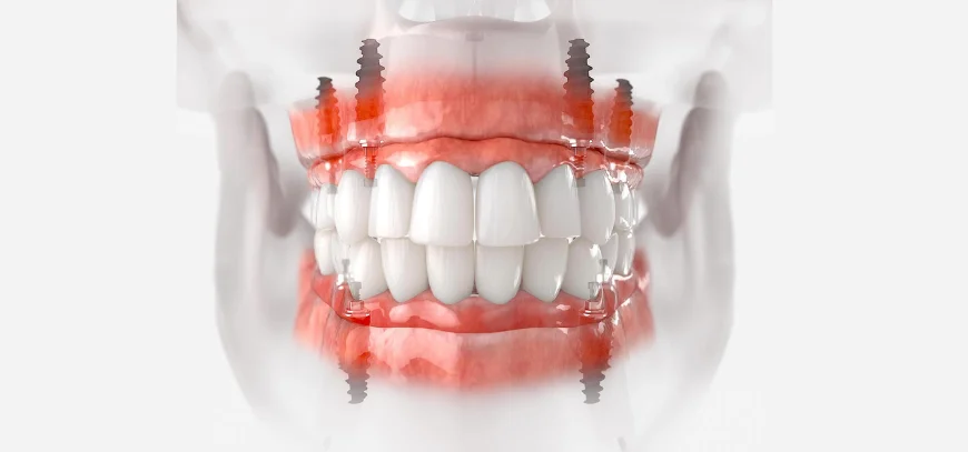 Implant Dentistry: A Modern Solution for a Confident and Healthy Smile